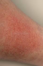 Image result for Photodermatitis
