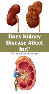 Diabetic Kidney Disease Kidney Disease Symptoms Kidney Disease Recipes Kidney Disease