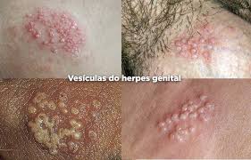 HERPES GENITAL | Cont&aacute;gio, Sintomas e Tratamento