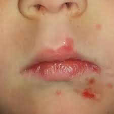The internal rash (the enanthem) consists of blisters and little ulcers that may involve not only the lining of the mouth but also the gums, palate, and tongue. Hand Foot And Mouth Disease Is Going Around What To Watch For