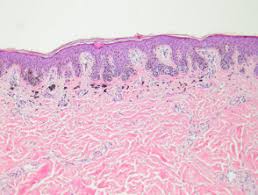 Lentigo simplex is a common benign melanocytic lesion. Lentigo Pathology Dermnet Nz