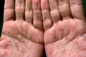 Image result for skin rash acute hiv infection