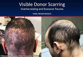 Fue punches the hair follicles out of the scalp, limiting the success of follicle removal coupled with an inefficient use of the precious donor area. When Hair Transplants Go Wrong Express Digest