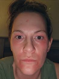 What helps fibromyalgia flare ups?