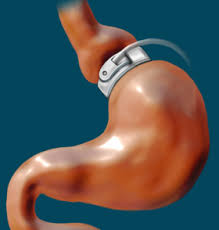 Adjustable Gastric Band Wikipedia