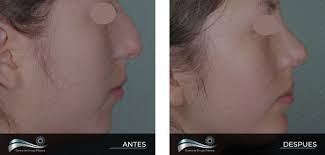 Mentón»Genioplastia»