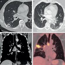Historically, tularaemia was a public health problem in the former soviet union and in the usa. Pulmonary Tularaemia A Differential Diagnosis To Lung Cancer European Respiratory Society