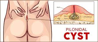 A pilonidal cyst (also called pilonidal cyst disease, intergluteal pilonidal disease or pilonidal sinus) is a skin condition that happens in the crease of the buttocks — anywhere from the tailbone to the anus. Everything You Need To Know About Pilonidal Cysts Dasarimd