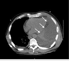 Pleural effusions occur as a result of increased fluid formation and/or reduced fluid resorption. Axial Image From Non Contrast Ct Of The Chest Showing A Large Download Scientific Diagram