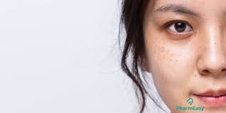 10 Home Remedies For Freckles & Clear Skin - Pharmeasy Blog