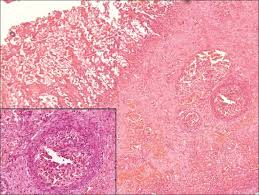 Infection with the fungus zygomycetes causes mucormycosis (zygomycosis). Gastrointestinal Mucormycosis In An Infant
