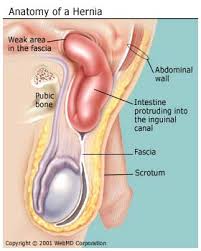 Hard to say without reviewing your diagnostic studie. What Is A Hernia Inguinal Incisional Umbilical Hiatal And Femoral Hernias
