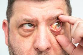 Image result for Conjunctivitis