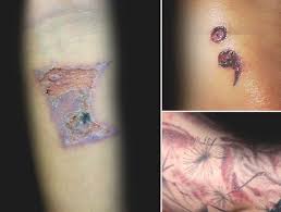 Tattoo Infection 101 How Do You Know If Your New Ink Is Infected