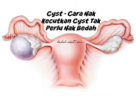 Baca punca cyst ovari (sista ovari) dan cara mengecutkannya! Cyst Cara Nak Kecutkan Cyst Tak Perlu Nak Bedah Bebelsihat Com