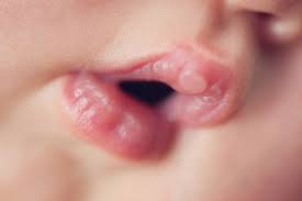 Was Sie Tun Konnen Wenn Babys Herpes Haben
