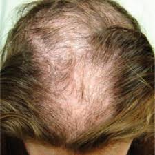 I'll go over a number of ways that are kn. Hair Loss At A Very Young Age Clinician Reviews