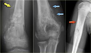 Fundamentals of body ct (fundamentals of radiology) $71.55 (48) in stock. The Radiology Assistant Differential Diagnosis Of Bone Tumors