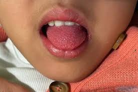 Image result for brown tongue symptoms