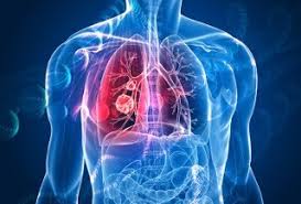 Catching cancer early will improve your chances of. First Reported Case Of Six Year Survival For Patient With