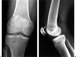 Lower extremity of right femur viewed from below. The Knee Radiology Key