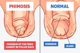 Image result for paraphimosis