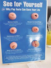 Other symptoms of cervical cancer may include pain and discomfort during sex, unusual or unpleasant vaginal discharge, and pain in your lower back or pelvis. Introductory Chapter Cervical Cancer Screening Treatment And Prevention Intechopen