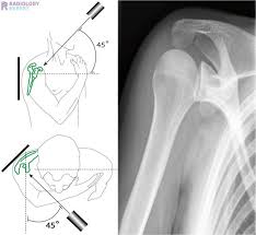 Image result for Shoulder XRay