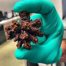 Ever Seen A Bladder Stone Like This These Stones Are Often Composed Of Calcium Oxalate And They Form In The Crevices And Trabecu Bladder Calcium Stones Stone