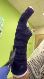 Image result for Ulnar Gutter Cast