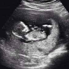 Kann Man Hier Das Geschlecht Des Babys Erkennen Schwangerschaft Baby