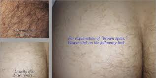 Many products and methods claim to remove butt hair, but only a few techniques effectively eliminate unwanted it effectively. Krozenwart 08152054076 Just Apply 7 Times On Butt Hair By Bizo Cream For Permanent Removal Results