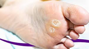 Image result for Corns