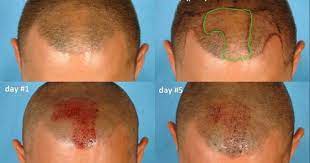 Neograft Hair Transplant Will This New Device Make Fue More Affordable And Safe Fue Hair Transplant Hair Transplant Hair Transplant Cost