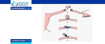 Tubal Ligation Reversal In Iran Iranian Surgery