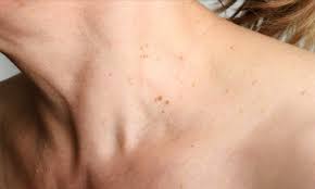 3 Razones Por Las Que Salen Verrugas En El Cuello El Pinero Periodismo Y Debate