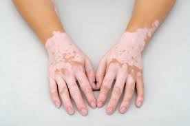The areas of skin most commonly affected by vitiligo include 2 307 Vitiligo Fotos Kostenlose Und Royalty Free Stock Fotos Von Dreamstime