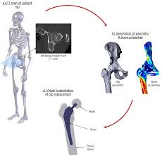 stress and fatigue in modular implants used in hip joints