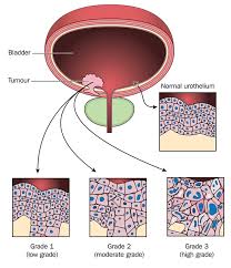Your urinary system — which includes your kidneys, ureters, bladder and urethra — removes waste from your body through urine. Bladder Cancer Symptoms Seek An Evaluation For Early Detection University Health News