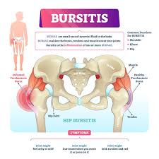 Hip tendonitis is painful inflammation or irritation of a tendon in the hip. Why Does My Hip Hurt When I Walk Bone Joint