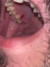 Image result for Erythroplakia roof of mouth