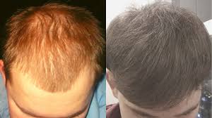 Can microneedling cause temporary hair shedding. Can Derma Rolling Cause Some Temporary Shedding Youtube