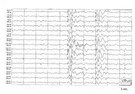 Manga that mans epilepsy bahasa indonesia selalu update di mangadewasa. Childhood Only Epilepsy With Generalized Tonic Clonic Seizures A Well Defined Epileptic Syndrome Sciencedirect