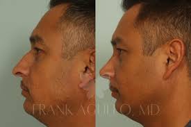 Check spelling or type a new query. Male Rhinoplasty El Paso Tx Frank Agullo Md