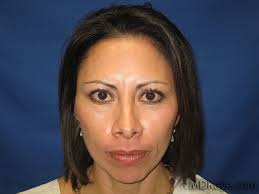 Injectable Fillers Gallery