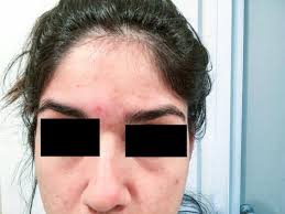 Preparing for laser hair removal is easy. Can Electrolysis Help Improve My Low Hairline Photo