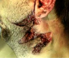 A gunshot wound (gsw) is physical trauma caused by a scattershot or a bullet from a firearm. Pathology Outlines Gunshot Wounds