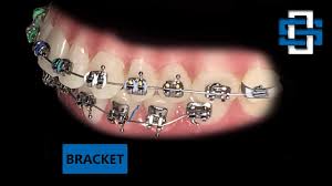 How to take care of your child's braces. Life With Braces Macon Warner Robins Spillers Orthodontics