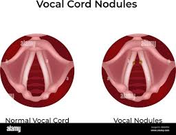 Image result for Vocal Cord Dysfunction