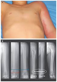 Image result for Osteomyelitis XRay